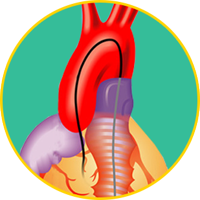 Angiography | Angina Awareness India